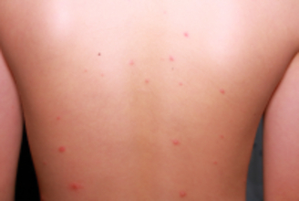 大正健康ナビ、10/29新着情報  かゆみを伴う水ぶくれの発疹ができる感染症 「水ぼうそう(水痘)」 を公開!