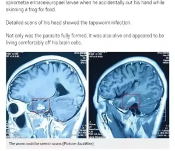 脳から11cmの寄生虫を摘出　19歳男性、激しい頭痛で判明（中国）