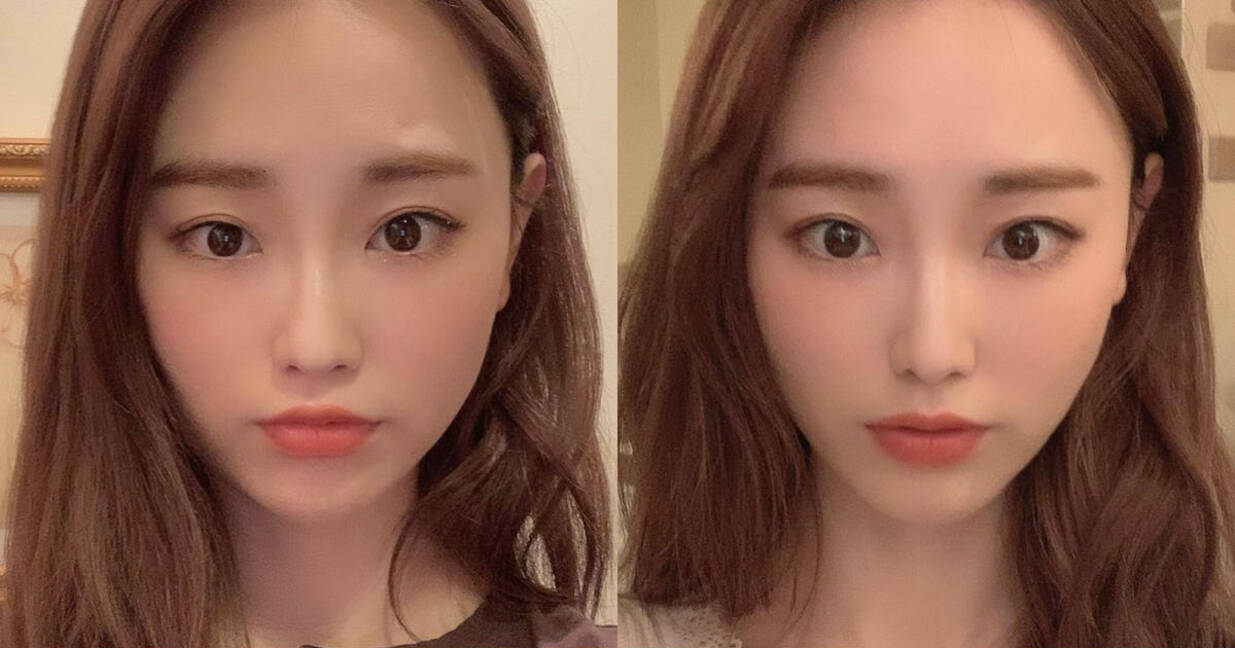 Before After 効果を実感 美容鍼灸を徹底レポ ローリエプレス