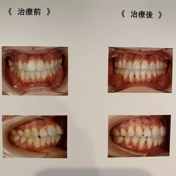大人の歯列矯正 アラサーの大事な４年を捧げた歯並び改善の その後 ローリエプレス