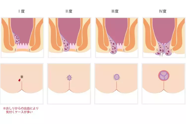 イボ痔の治し方ってありますか 手術って必要 医師が回答 30代の痔 ローリエプレス