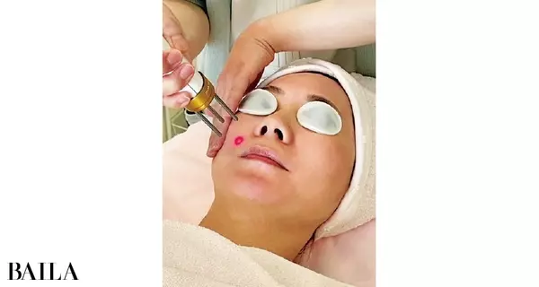 毛穴ケア 開き毛穴やたるみ毛穴におすすめ美容医療3選 ローリエプレス