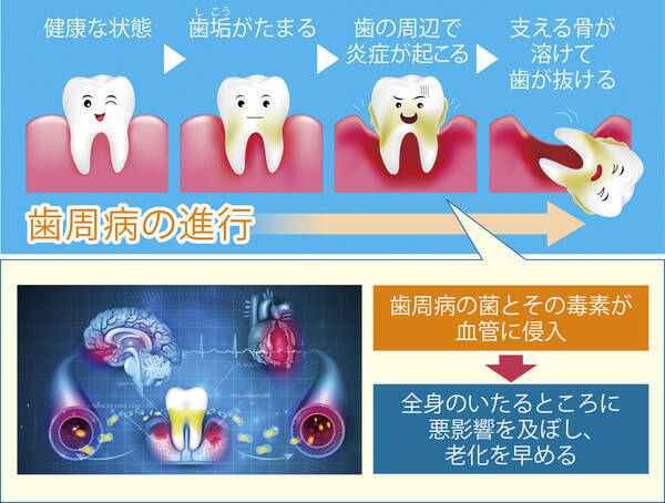 歯周病は認知症や子宮内膜症のリスクを高める 老化を止める口腔内ケアを歯科医院長が解説 ローリエプレス