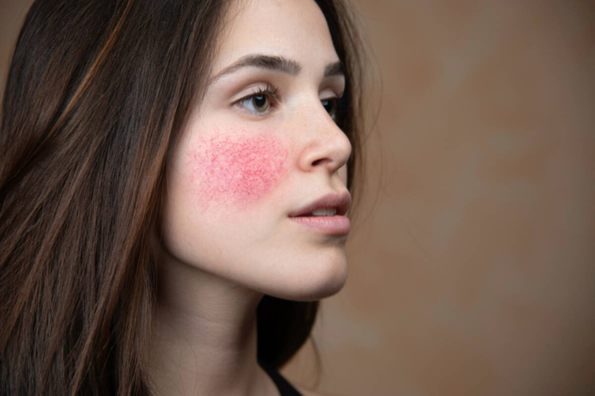 治療が難しい 気になる赤ら顔 効果的なケア方法を徹底解説 ローリエプレス