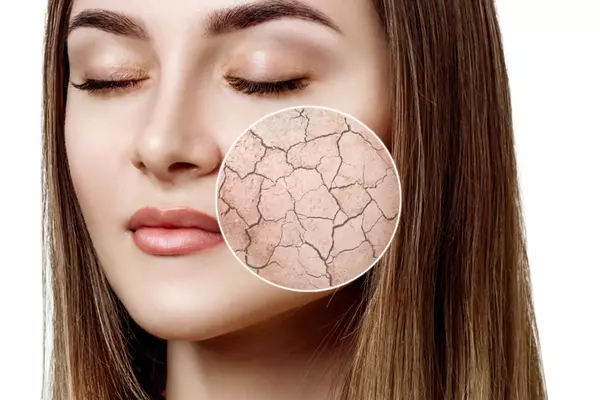 肌の乾燥で化粧水が入らない理由と対処法 肌のうるおい約3倍アップを目指す ローリエプレス