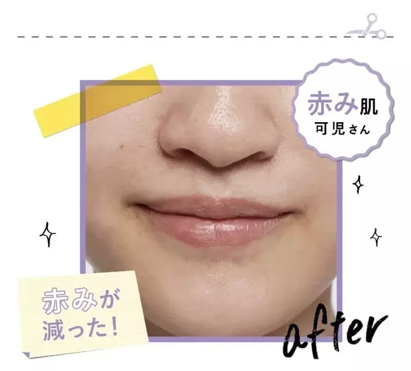 乾燥肌もニキビも改善 ドラッグストアで買える敏感肌用の名品スキンケアって ローリエプレス