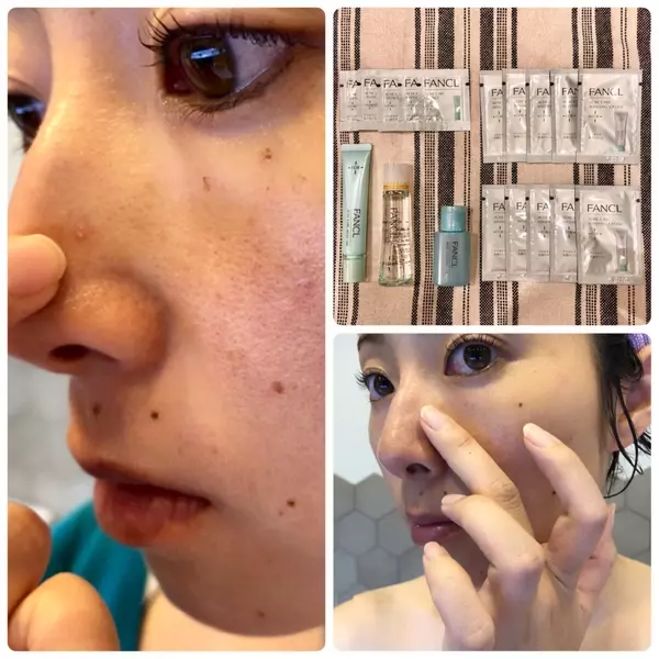 なんと1000円のお試しセット アラサーayakoの治らない大人ニキビの時のスキンケア ローリエプレス