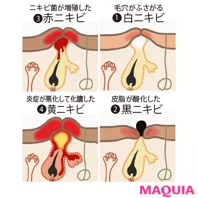 ニキビは病気って本当 夏に悪化するのは気のせい 大人ニキビの原因をq Aでおさらい ローリエプレス