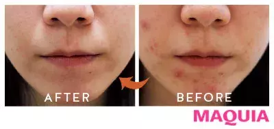 肌がきれいにならないと悩むあなたへ スキンケアの効きが格段にアップする方法とは ローリエプレス 肌がきれいにならないと悩むあなたへ スキンケアの効きが格段にアップする方法とは ローリエプレス