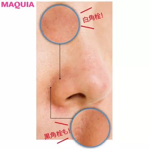 2週間で毛穴徹底解消 白黒詰まり毛穴 メラニン 詰まり毛穴さん必見のケアテク ローリエプレス