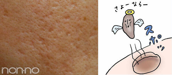 ニキビ跡 クレーター の原因 治し方 隠し方 ニキビのことぜんぶ ローリエプレス