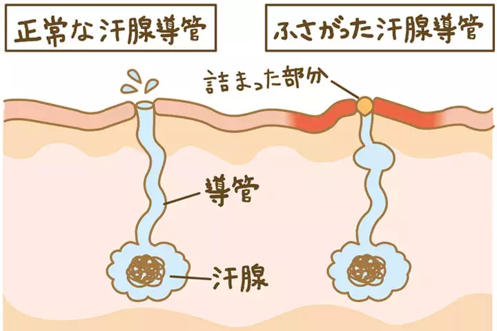 大人のそれって あせも じゃないかも 実は 放置すると重症化するかもしれない 汗あれ かも ローリエプレス