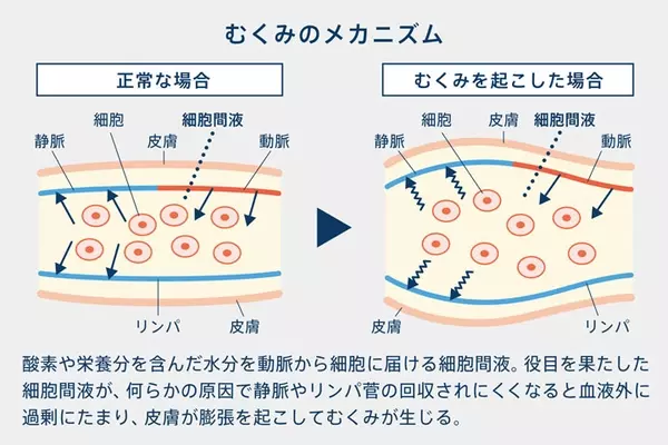 猛暑も冷房も辛い 夏のむくみサヨナラ たった10分 自分で簡単にできるむくみ対策 ローリエプレス