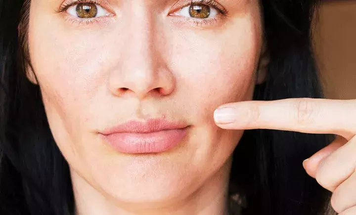 口回りにほわほわ生えている女性ヒゲ 毛抜きで抜くのはあり ローリエプレス