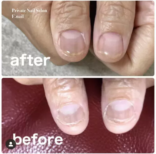 深爪に悩む方必見 ネイルサロンで深爪改善 ローリエプレス