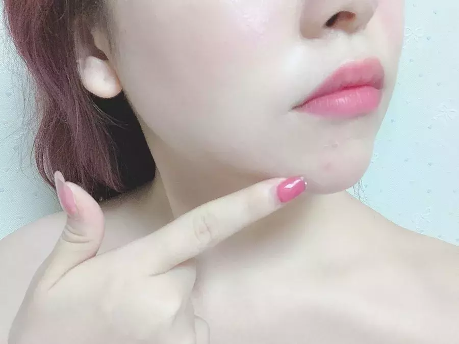 ニキビの応急処置に塗る韓国ケアコスメ3選 スポットで狙って集中ケア ローリエプレス