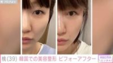 桃、韓国で3月に受けた美容整形ビフォーアフター「ほうれい線全然違う！」「美人さん発見しました」と反響