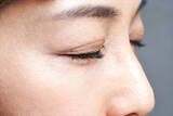「宮根誠司さんが治療した「眼瞼下垂」」の画像1