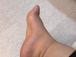 「痛風ですか？」女性お笑いタレント、“足首が見当たらないの”吐露「2歳児のあんよだ」「うちの赤ちゃんと一緒」