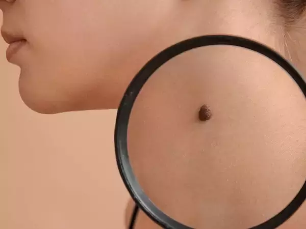 「ほくろを取ると、がんになる」って本当？ セルフチェックのポイントを医師が解説！