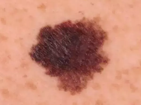 「「ただのシミ」と思っていたら皮膚がんだった……見逃してはいけない危険なシミの違い・見分け方」の画像