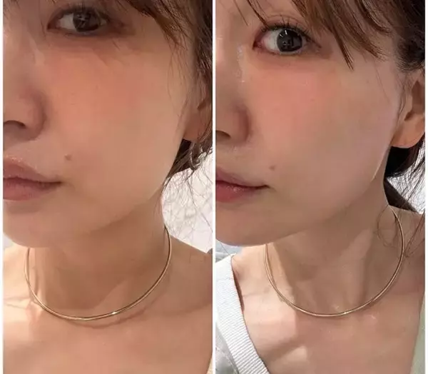 あいのり・桃、糸リフト施術後の変化に驚き「中顔面が短く見える気がしない？！」