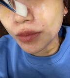 「あいのり・桃、医師も驚きのニキビ治療を報告「なかなか珍しいですねって言われた」」の画像1