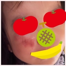 高橋真麻、転倒し傷だらけになった娘の顔に「痛々しい」
