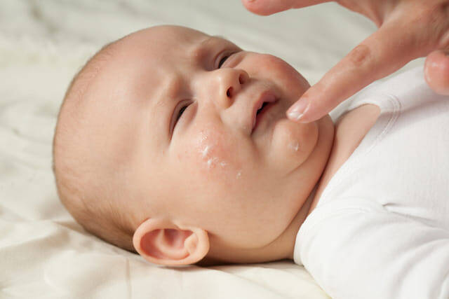 食物アレルギーの原因は皮膚だった 赤ちゃんのアレルギー発症を防ぐ 予防スキンケア とは 21年3月9日 エキサイトニュース