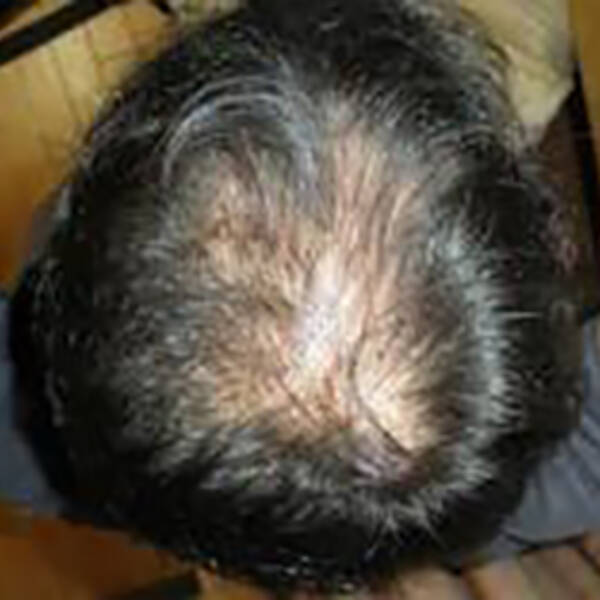 亜鉛 の摂取が薄毛予防のポイントだった 15年5月12日 エキサイトニュース