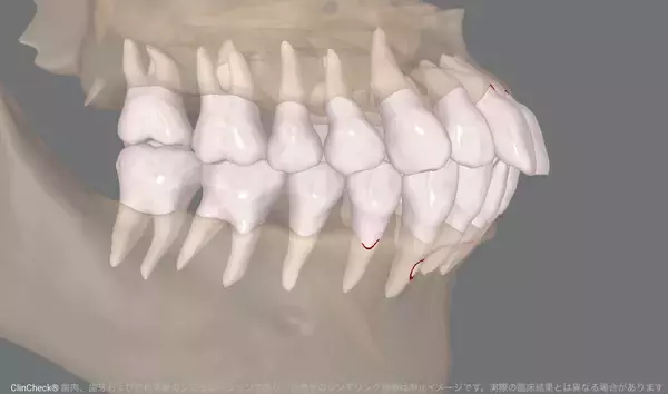 70歳で矯正治療を開始AIとマウスピース矯正が後押しする「期限を決めた歯科治療」という選択