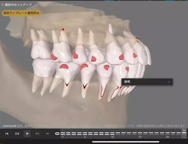 「70歳で矯正治療を開始AIとマウスピース矯正が後押しする「期限を決めた歯科治療」という選択」の画像