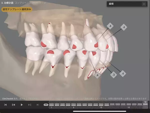 「70歳で矯正治療を開始AIとマウスピース矯正が後押しする「期限を決めた歯科治療」という選択」の画像