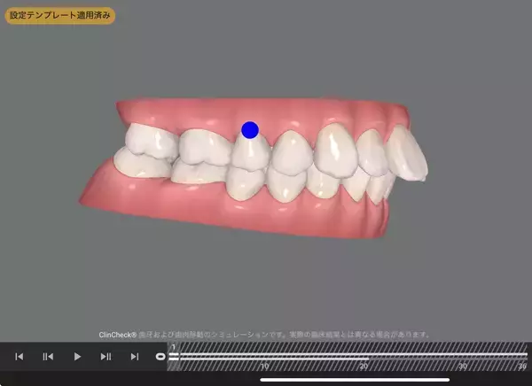 70歳で矯正治療の反響で増える「大人の歯並び相談」