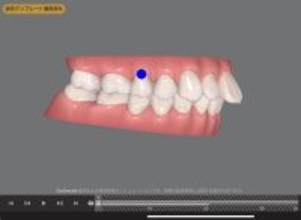 70歳で矯正治療の反響で増える「大人の歯並び相談」