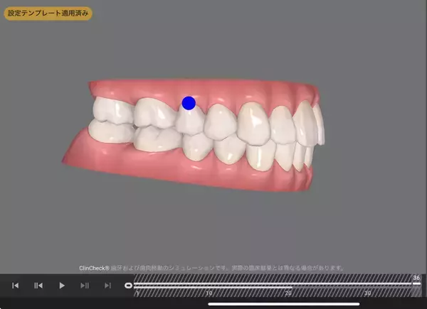 「70歳で矯正治療の反響で増える「大人の歯並び相談」」の画像