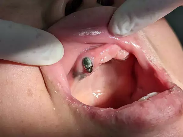 「死亡率を下げる夜専用「おやすみ入れ歯」　日本初の入れ歯型マウスピースが、提供開始3年で製作数160個超え」の画像