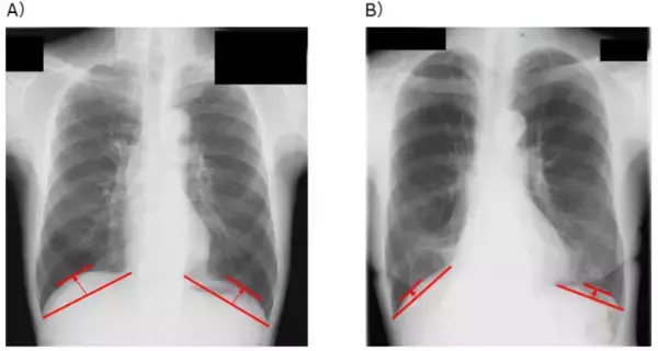 肺がん患者の手術前の横隔膜の位置と予後の関連性を検証　手術のリスク評価や治療戦略立案への貢献が期待される研究成果