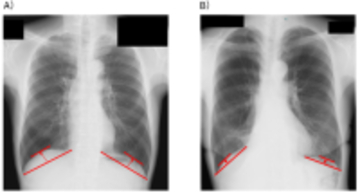 肺がん患者の手術前の横隔膜の位置と予後の関連性を検証　手術のリスク評価や治療戦略立案への貢献が期待される研究成果