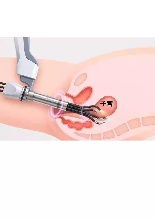 「大阪初！関西メディカル病院、最新鋭ロボットを用いたvNOTES子宮全摘術開始」の画像