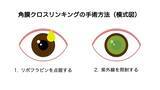 「未成年の円錐角膜患者に、治療の機会を届けたい　一般社団法人円錐角膜支援の会が、角膜クロスリンキング治療費支援のためのクラウドファンディングを開始」の画像3