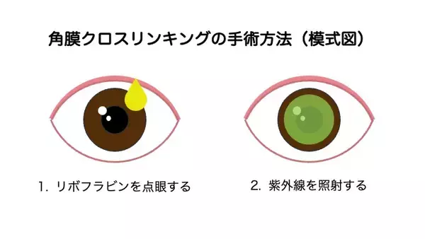 「未成年の円錐角膜患者に、治療の機会を届けたい　一般社団法人円錐角膜支援の会が、角膜クロスリンキング治療費支援のためのクラウドファンディングを開始」の画像