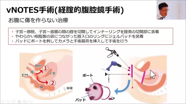 「子宮筋腫・過多月経などに対する婦人科手術講座と動画公開」の画像
