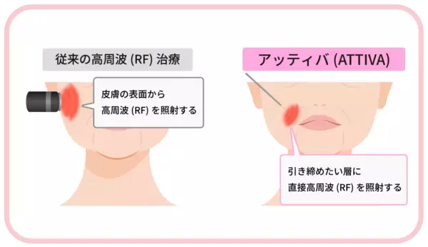 「東海地方初導入　名古屋・栄で進化するたるみ治療　まゆりなclinic名古屋栄、次世代高周波治療器「ATTIVA(アッティバ)導入」」の画像