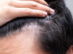 【朗報】自毛のように機能する毛包の培養に成功！薄毛治療に新たな可能性