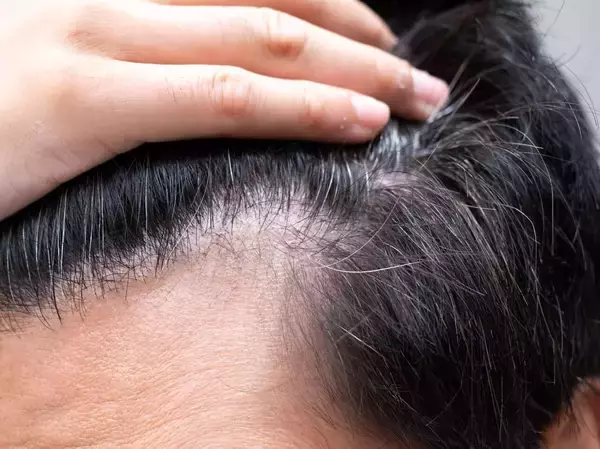 【朗報】自毛のように機能する毛包の培養に成功！薄毛治療に新たな可能性