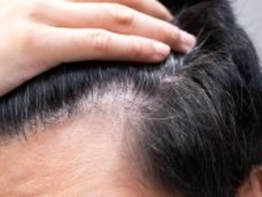 【朗報】自毛のように機能する毛包の培養に成功！薄毛治療に新たな可能性