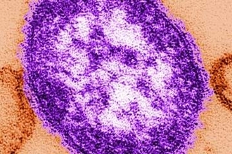 成人女性がはしかの合併症で死亡、米ペンシルベニア州で感染が急拡大
