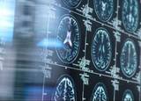 「高齢の脳、リチウムでアルツハイマー病防げる可能性　25年研究」の画像1