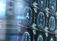 高齢の脳、リチウムでアルツハイマー病防げる可能性　25年研究